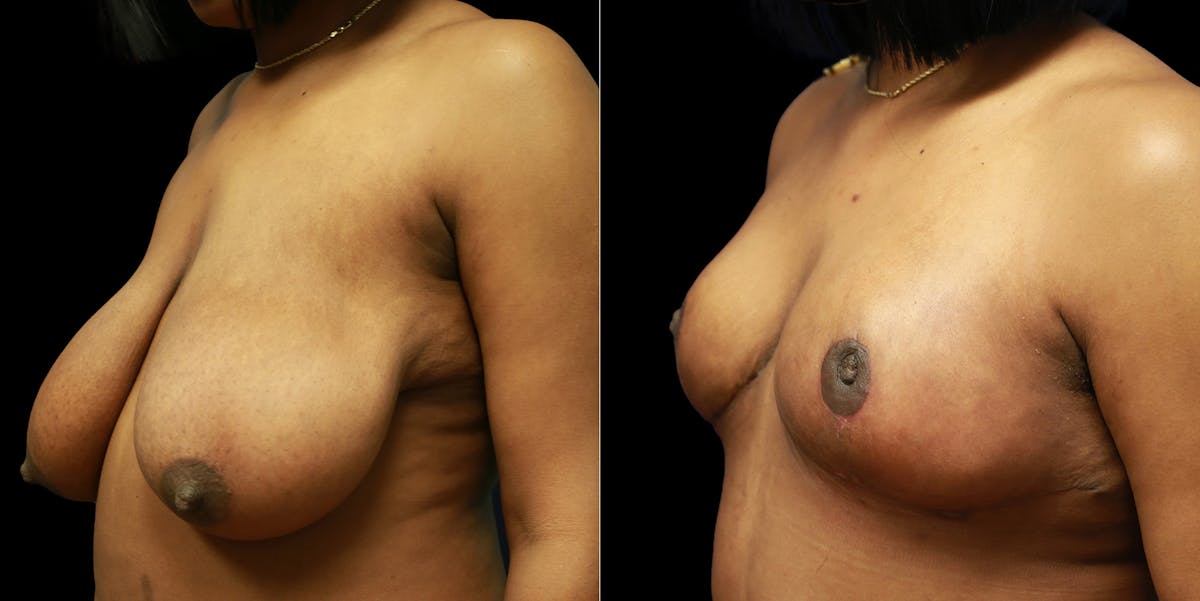 Breast Reduction Before & After Gallery - Patient 356790 - Image 4