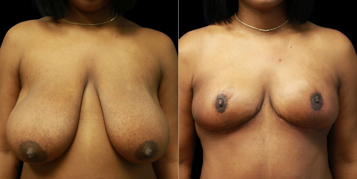 Breast Reduction Before & After Gallery - Patient 356790 - Image 1