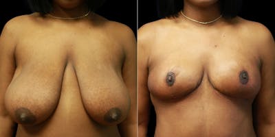Breast Reduction Before & After Gallery - Patient 356790 - Image 1