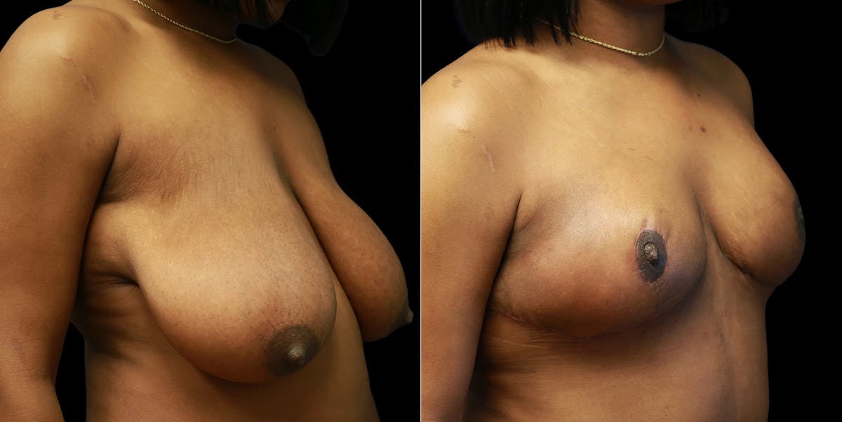 Breast Reduction Before & After Gallery - Patient 356790 - Image 2