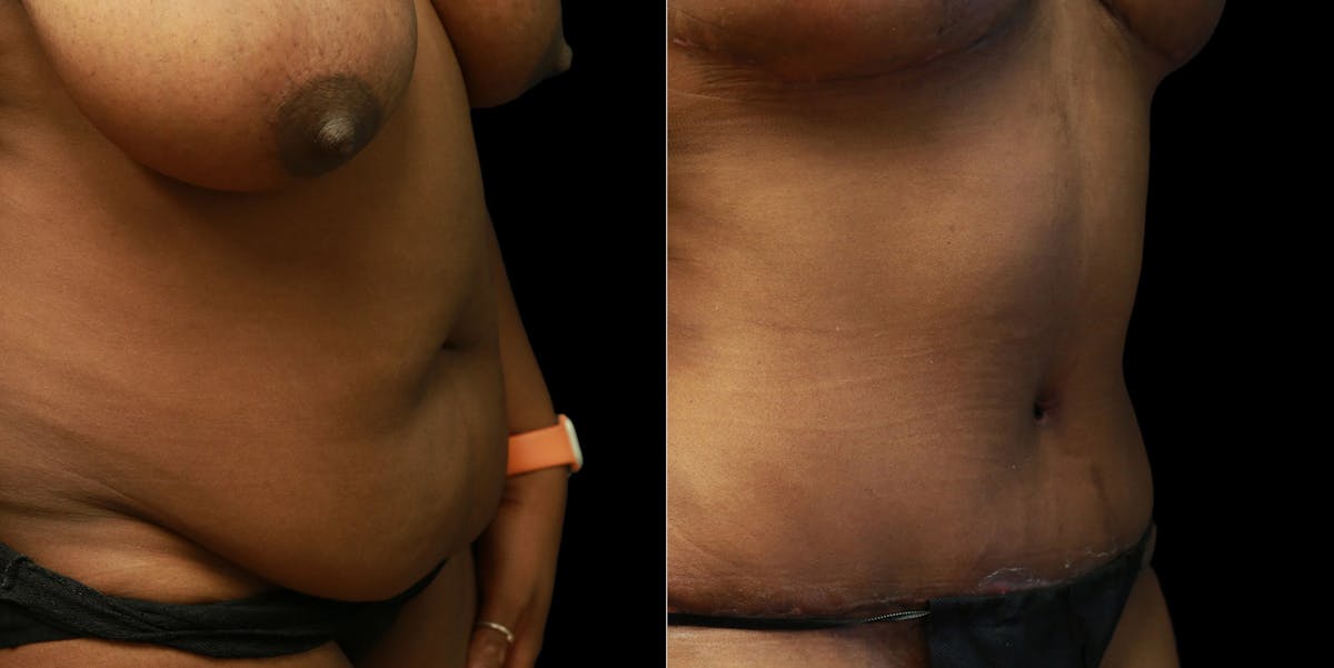 Abdominoplasty Before & After Gallery - Patient 377290 - Image 2