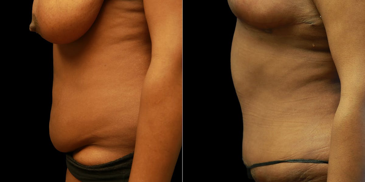 Abdominoplasty Before & After Gallery - Patient 377290 - Image 5