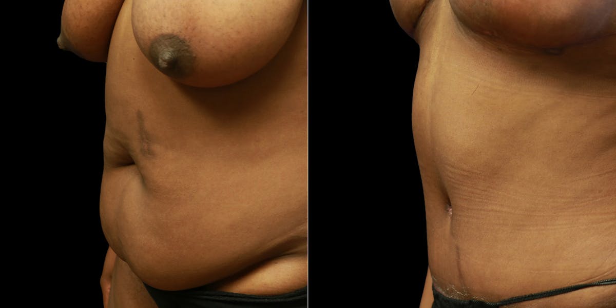 Abdominoplasty Before & After Gallery - Patient 377290 - Image 4