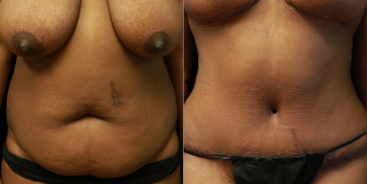Abdominoplasty Before & After Gallery - Patient 377290 - Image 1