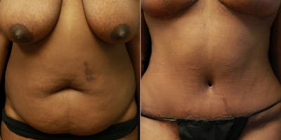 Panniculectomy Before & After Gallery - Patient 200400 - Image 1