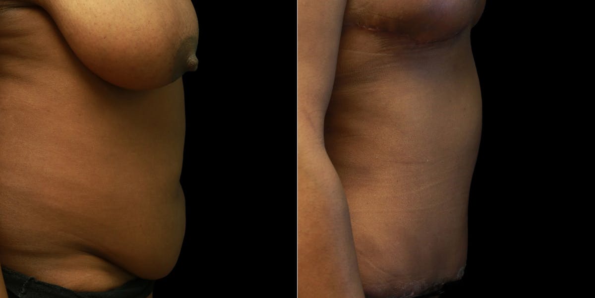 Abdominoplasty Before & After Gallery - Patient 377290 - Image 3