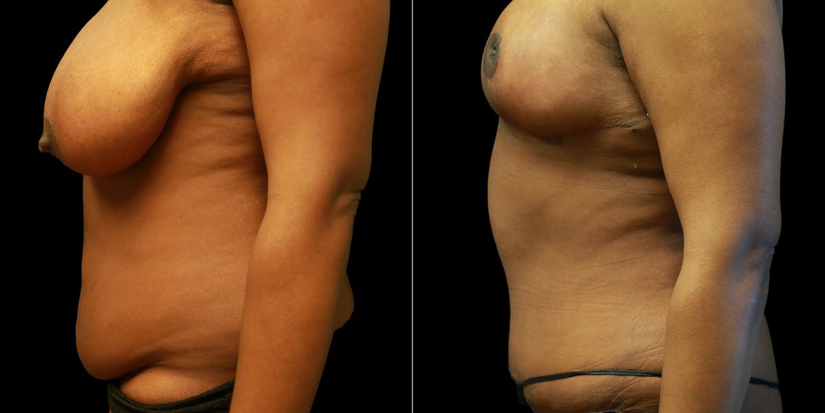 Mommy Makeover Before & After Gallery - Patient 771272 - Image 5