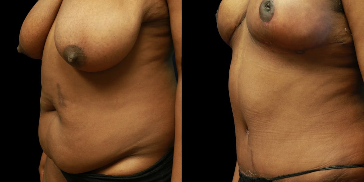 Mommy Makeover Before & After Gallery - Patient 771272 - Image 4