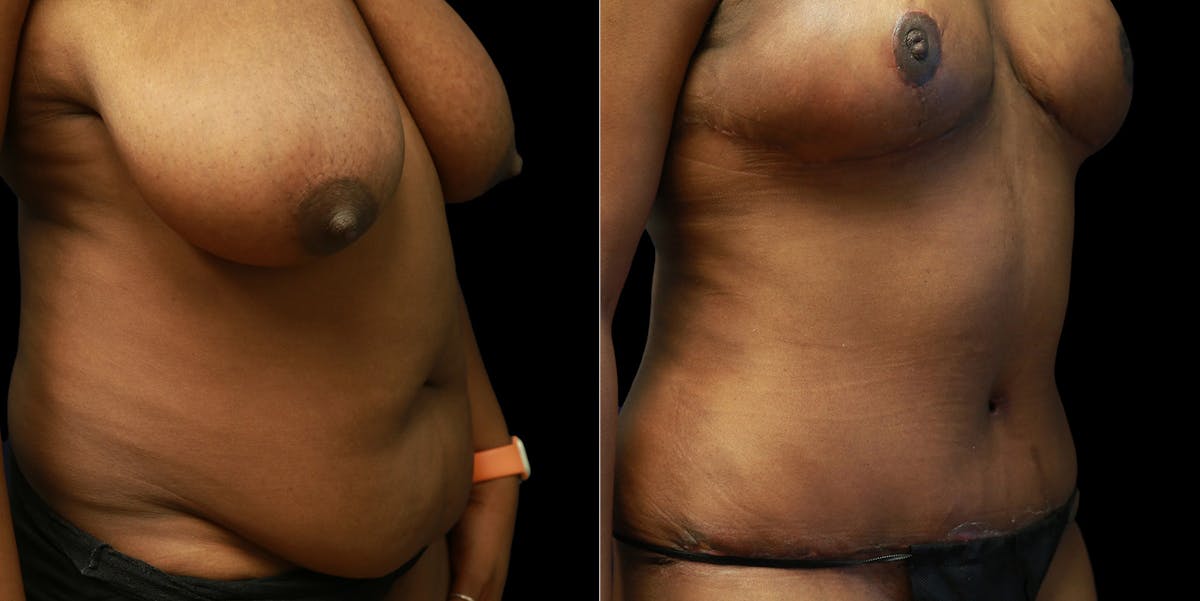 Mommy Makeover Before & After Gallery - Patient 771272 - Image 2