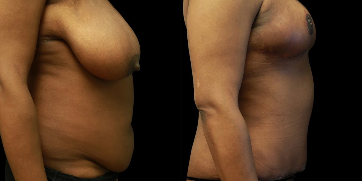 Mommy Makeover Before & After Gallery - Patient 771272 - Image 3
