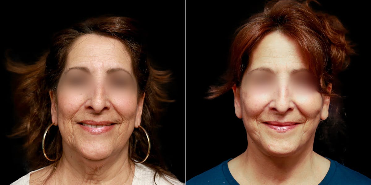 Facelift Before & After Gallery - Patient 113558 - Image 2