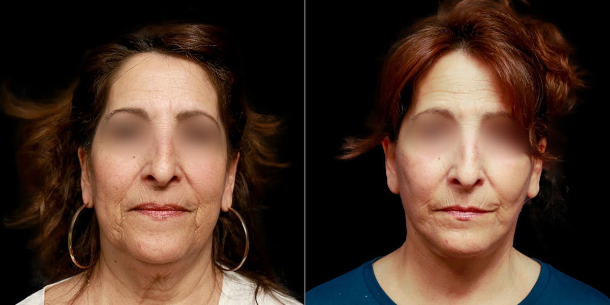 Facelift Before & After Gallery - Patient 113558 - Image 5