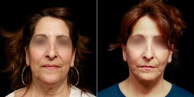 Lower Blepharoplasty Before & After Gallery - Patient 220574 - Image 1