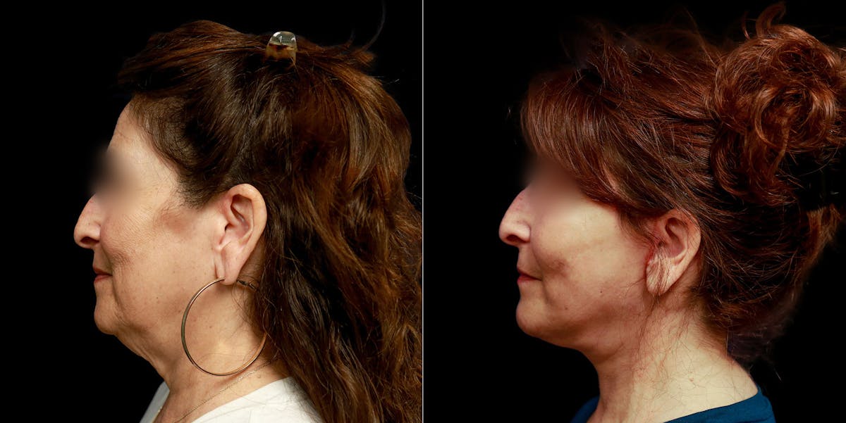 Facelift Before & After Gallery - Patient 113558 - Image 6