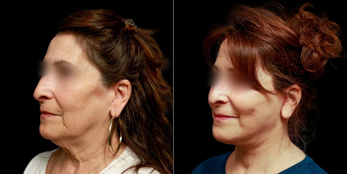 Facelift Before & After Gallery - Patient 113558 - Image 3