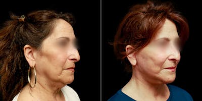 Facelift Before & After Gallery - Patient 113558 - Image 1
