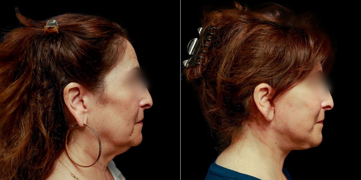 Facelift Before & After Gallery - Patient 113558 - Image 4