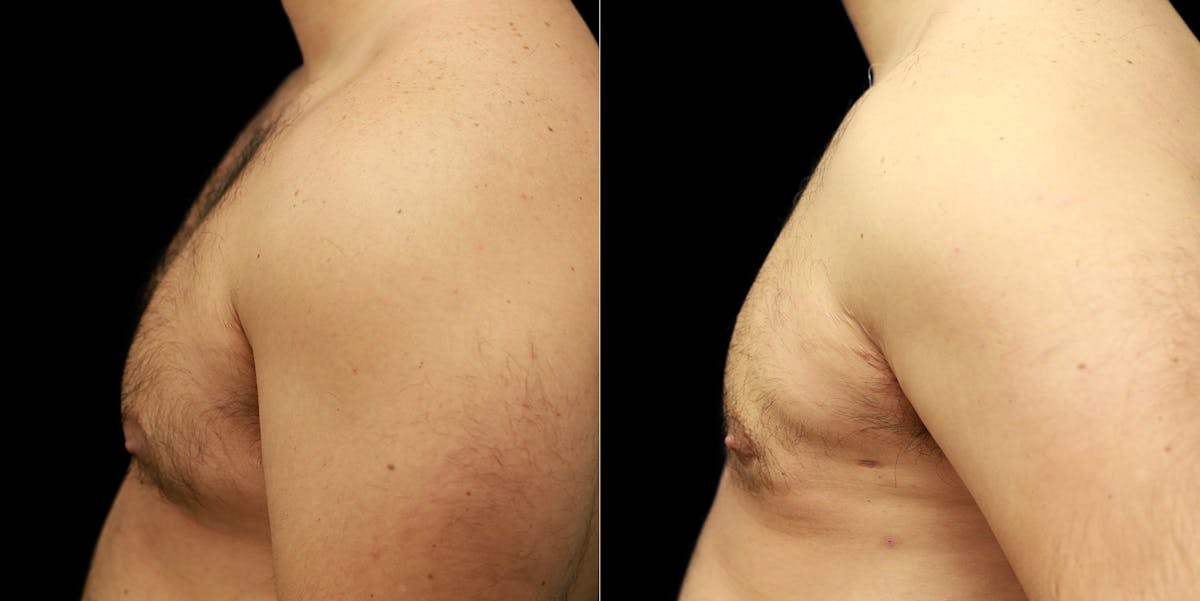 Gynecomastia Before & After Gallery - Patient 287244 - Image 3