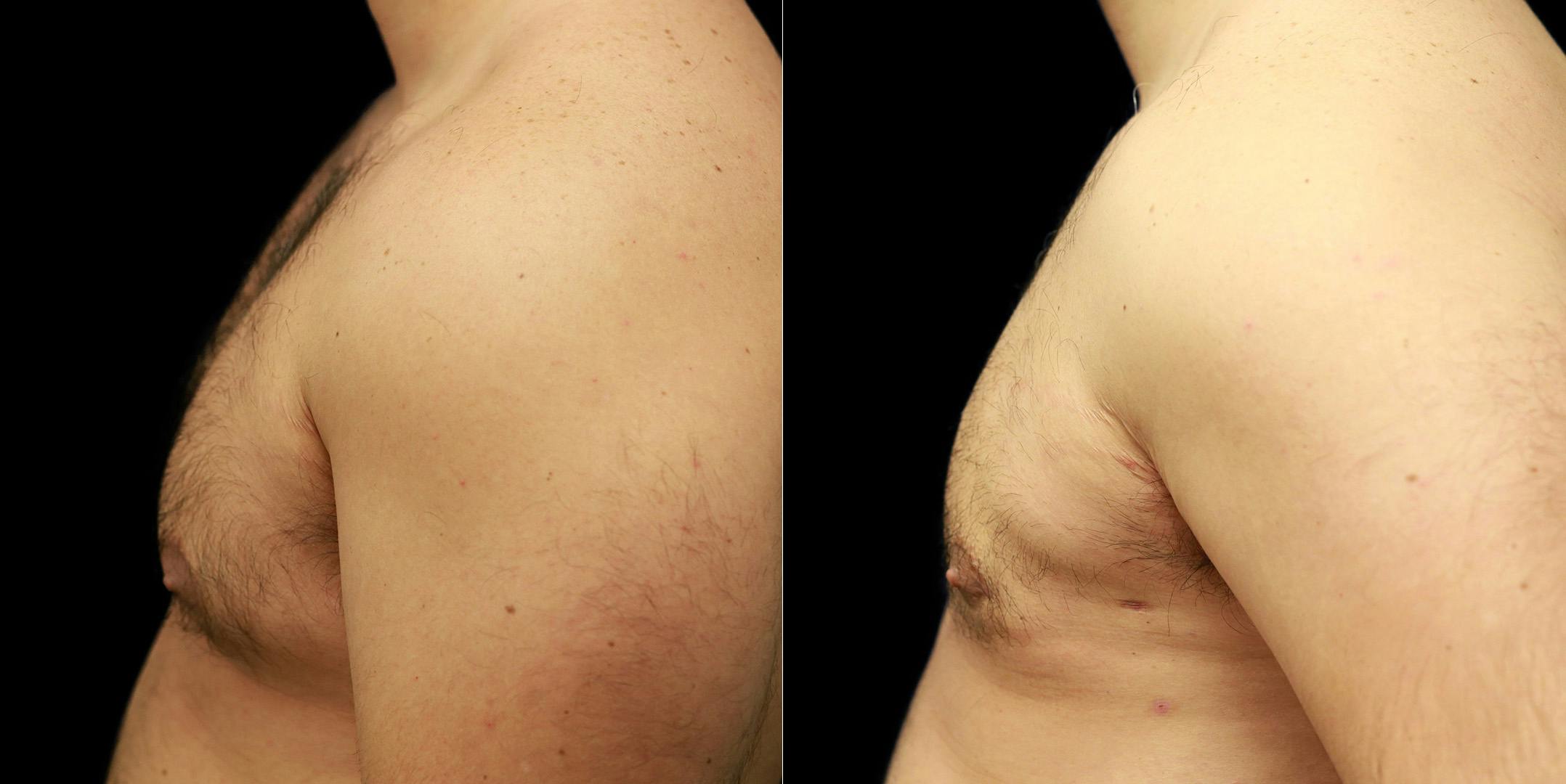 Gynecomastia Before & After Gallery - Patient 287244 - Image 3