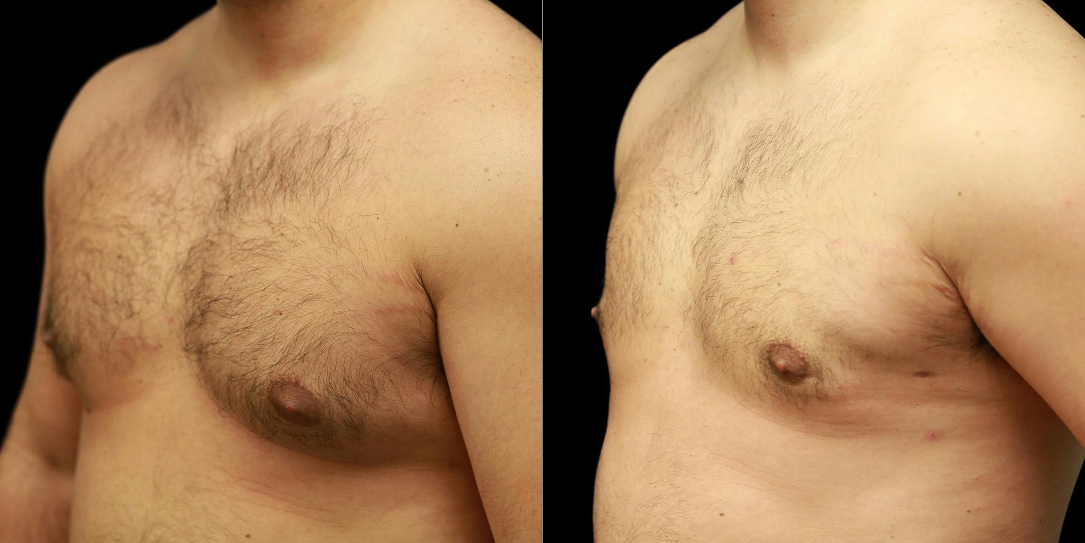 Gynecomastia Before & After Gallery - Patient 287244 - Image 5