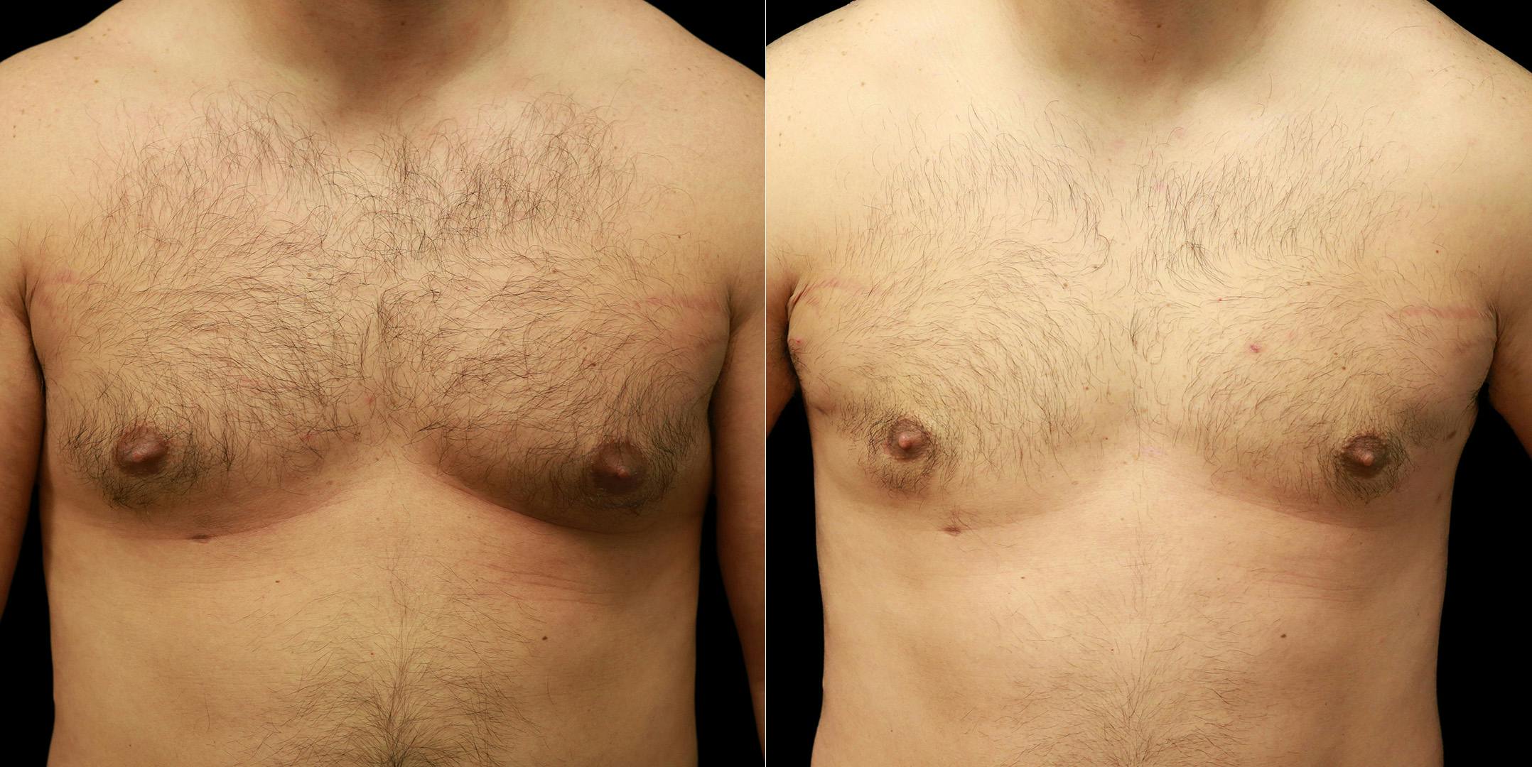 Gynecomastia Before & After Gallery - Patient 287244 - Image 1