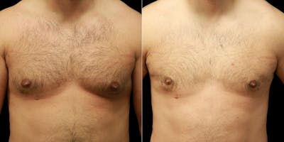 Gynecomastia Before & After Gallery - Patient 287244 - Image 1