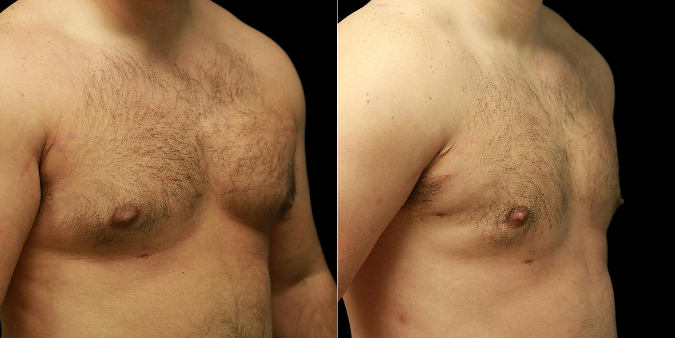 Gynecomastia Before & After Gallery - Patient 287244 - Image 2