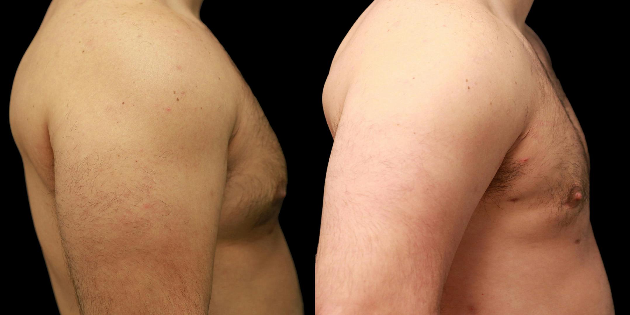 Gynecomastia Before & After Gallery - Patient 287244 - Image 4