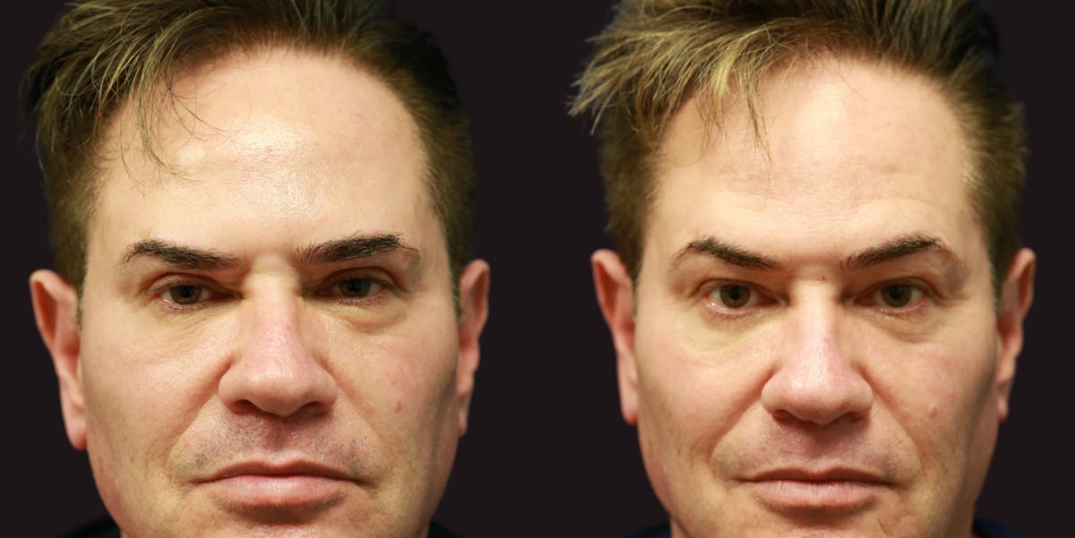 Upper Blepharoplasty Before & After Gallery - Patient 686935 - Image 1