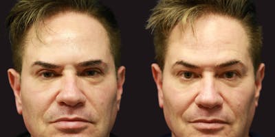 Upper Blepharoplasty Before & After Gallery - Patient 686935 - Image 1
