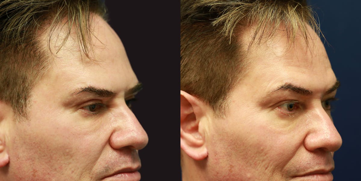 Upper Blepharoplasty Before & After Gallery - Patient 686935 - Image 3