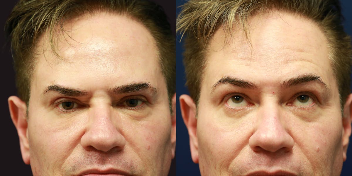 Upper Blepharoplasty Before & After Gallery - Patient 686935 - Image 4