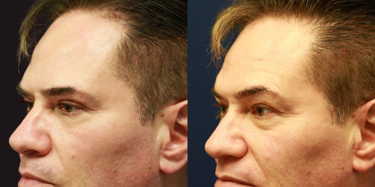 Upper Blepharoplasty Before & After Gallery - Patient 686935 - Image 2