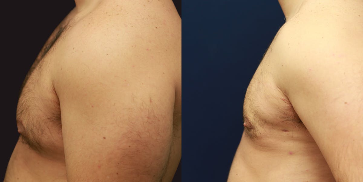 Gynecomastia Before & After Gallery - Patient 250244 - Image 4