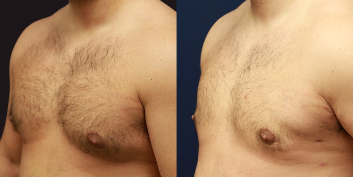 Gynecomastia Before & After Gallery - Patient 250244 - Image 3