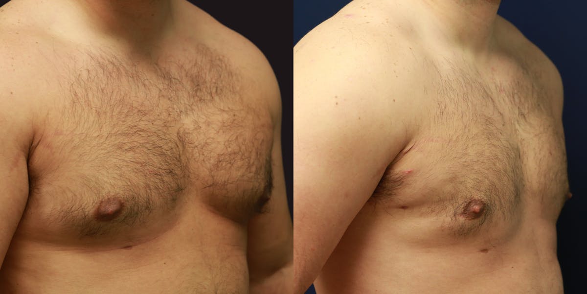 Gynecomastia Before & After Gallery - Patient 250244 - Image 2