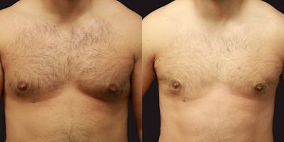 Gynecomastia Before & After Gallery - Patient 250244 - Image 1
