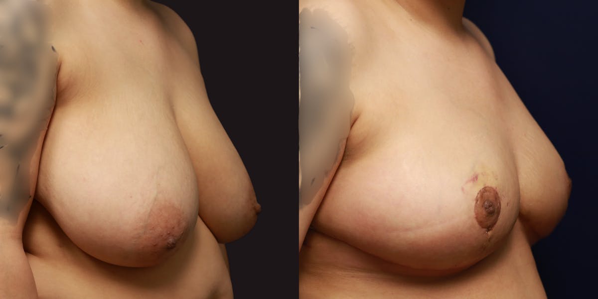 Breast Reduction Before & After Gallery - Patient 250510 - Image 3