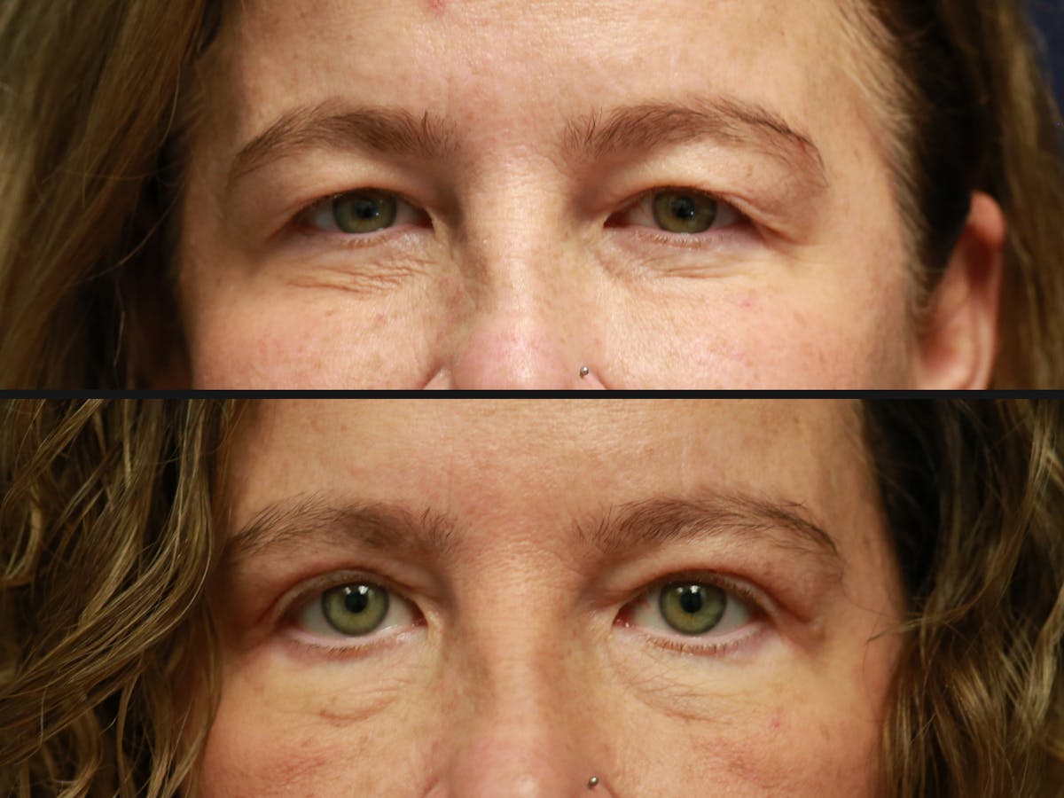 Upper Blepharoplasty Before & After Gallery - Patient 261811 - Image 2