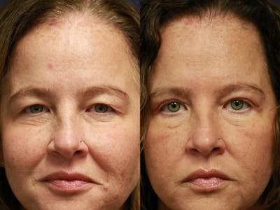 Upper Blepharoplasty Before & After Gallery - Patient 261811 - Image 1