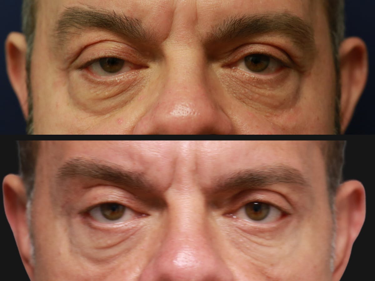 Upper Blepharoplasty Before & After Gallery - Patient 336401 - Image 2