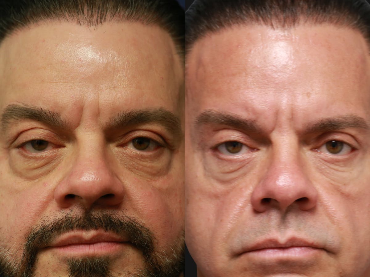 Upper Blepharoplasty Before & After Gallery - Patient 336401 - Image 1