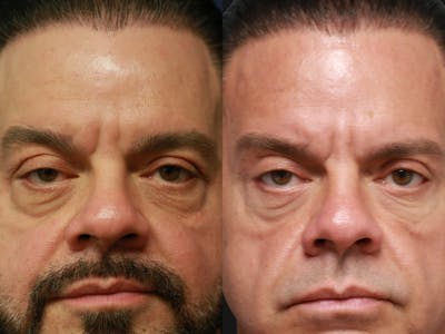 Upper Blepharoplasty Before & After Gallery - Patient 336401 - Image 1