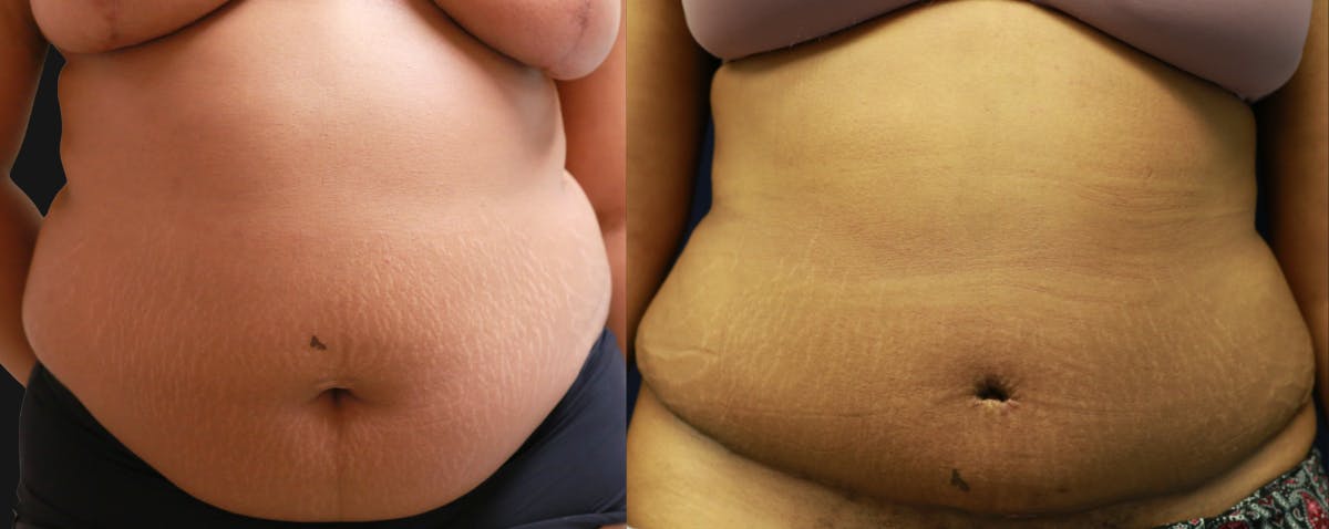 Abdominoplasty Before & After Gallery - Patient 263537 - Image 1