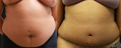 Abdominoplasty Before & After Gallery - Patient 263537 - Image 1