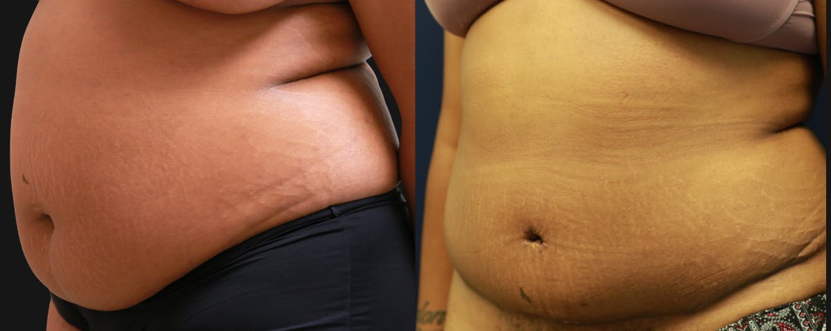 Abdominoplasty Before & After Gallery - Patient 263537 - Image 2
