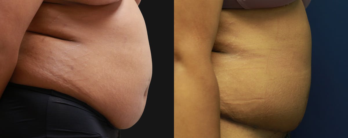 Abdominoplasty Before & After Gallery - Patient 263537 - Image 3