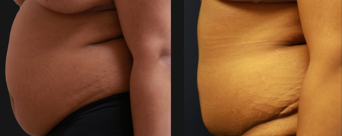 Abdominoplasty Before & After Gallery - Patient 263537 - Image 4