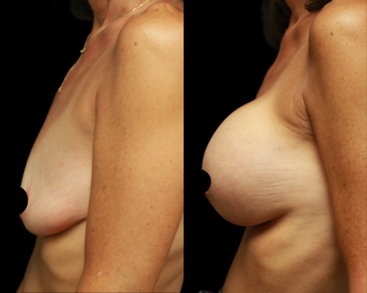 Breast Augmentation Before & After Gallery - Patient 108345 - Image 2