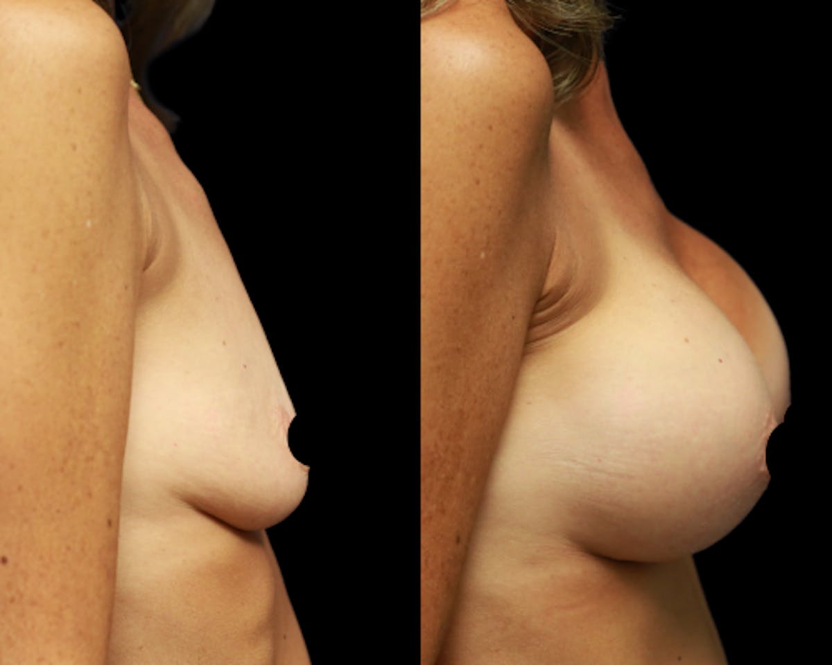 Breast Augmentation Before & After Gallery - Patient 108345 - Image 4